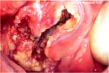 سرطان دهان و دخانیات